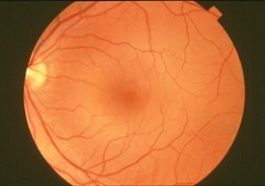 Normal Retina