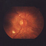 Proliferative Retinopathy