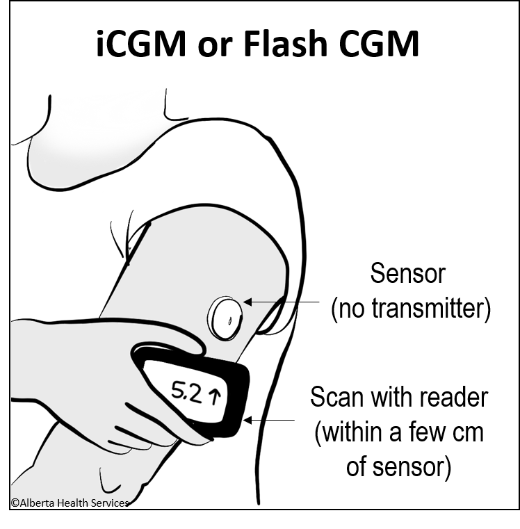 iCGM